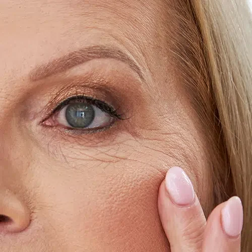 Clínica estética en Alicante, Medicina estética, tratamiento anti-arrugas