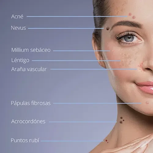Clínica estética en Alicante, Medicina estética, tratamiento eliminacion de manchas y lesiones benignas