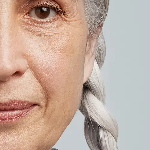 Clínica estética en Alicante, Medicina estética, tratamiento surcos nasogenianos