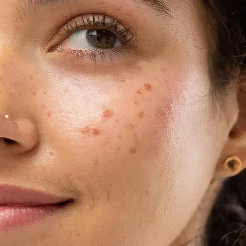 Clínica estética en Alicante, Medicina estética, tratamiento anti acné